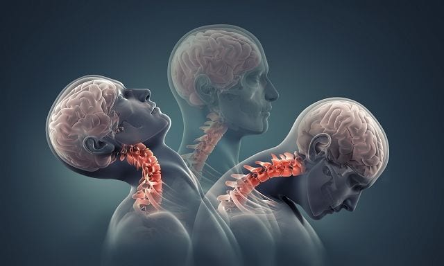 Schleudertrauma Zerrungen der Muskulatur, Sehen und Bänder sind maßgebliche Ursachen für ein Schleudertrauma
