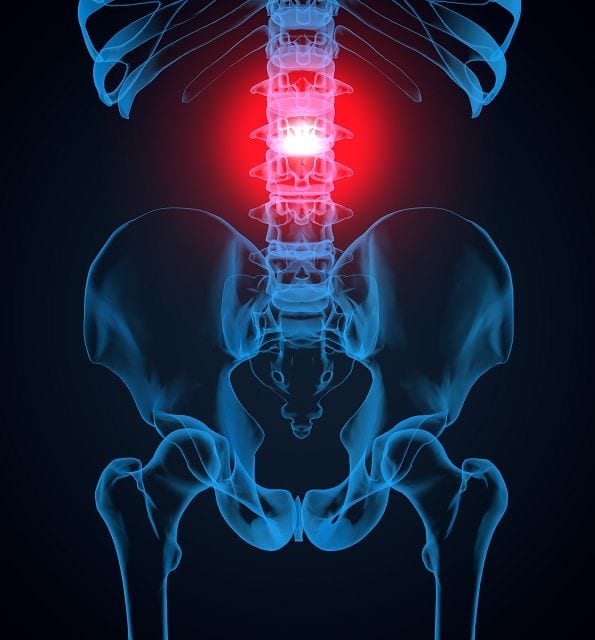 Für Entzündungen im Bereich der Wirbelsäule gibt es verschiedene Begriffe die die Region des Befalls beschreiben. Spondylitis bedeutet übersetzt "Wirbelkörperentzündung", Osteomyelitis wiederum heißt "Infektion des Knochenmarks", Osteitis ist eine "Knochenentzündung".