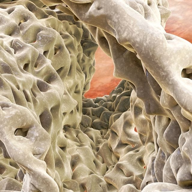 Bei Patienten sind an den betroffenen Knochenbereichen sogenannte Riesenosteoklasten zu finden, die um den Faktor fünf bei der Anzahl der Zellkerne vergrößert sind. Somit findet ein beschleunigter Knochenabbau statt.