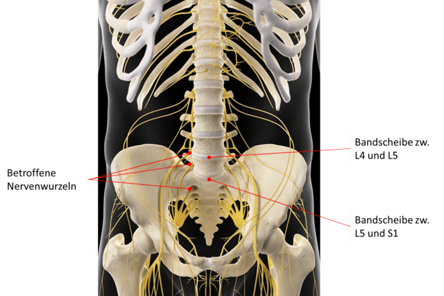 Bei einer Diskushernie der Bandscheiben zwischen den Wirbeln L4/L5 und L5/S1 kann es neben starken einschießende Schmerzen auch zu neurologischen Ausfallerscheinungen in den Beinen und Füßen kommen.