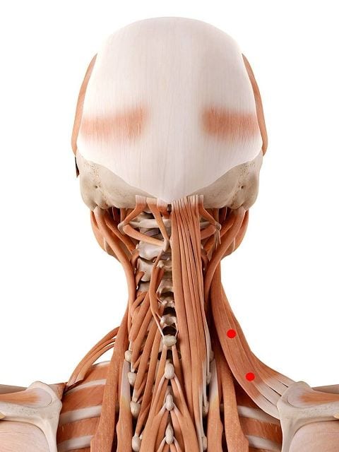 Triggerpunkte im Schulterblattheber (lat. levator scapulae) können Nackenschmerzen und einen Schiefhals (Torticollis) auslösen. Darüber hinaus kann es zu Bewegungsschmerzen in den Schultern kommen.