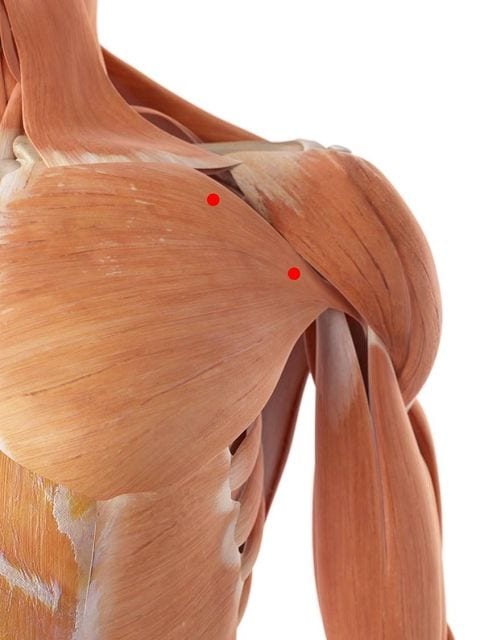 Triggerpunkte im großen Brustmuskel können zu ausstrahlenden Schmerzen im vorderen Schulterbereich führen.