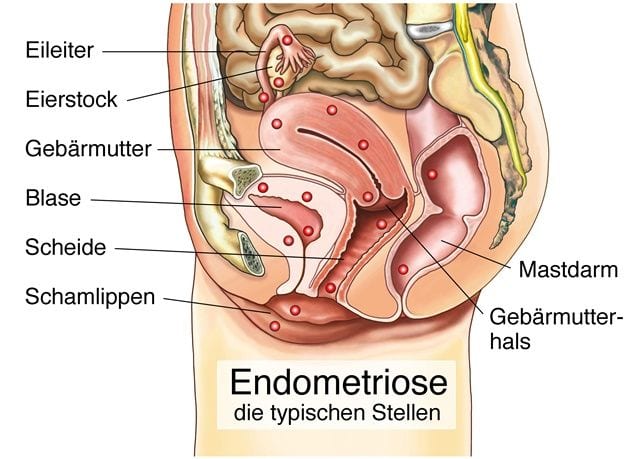 Endometriose ist eine chronisch, schmerzhafte Erkrankung der Organe im Bauchraum.